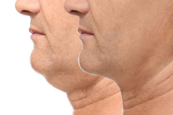 HIFU - Breakthrough in Anti - ageing 2 hifu results Godalming