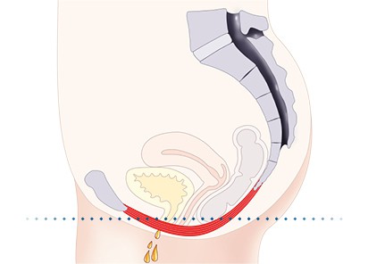 Pelvic-Floor Muscle Repair 5 Pelvic floor muscles Godalming