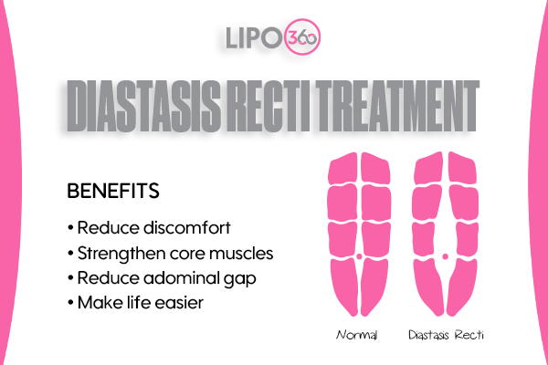 Revolutionising Muscle Repair: The Power of LIPO360 Body Sculpt Post-Injury 5 diastasis recti treatment Godalming