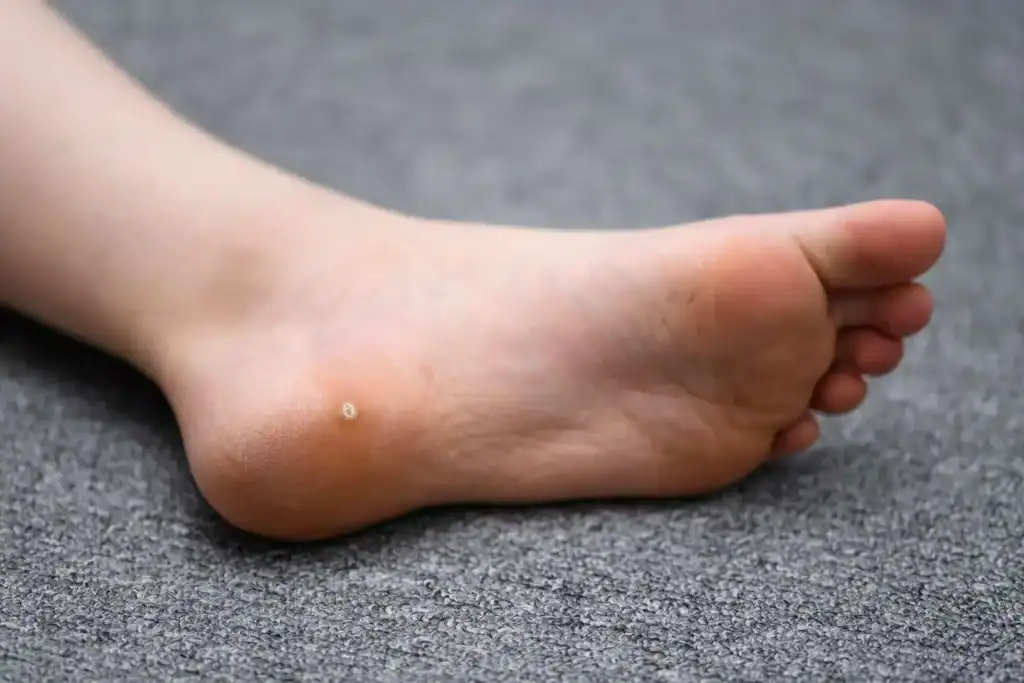 Cryotherapy For Warts And Also Verrucas 2 Image of verruca on the bottom of the foot that able to be treated with Cryotherapy Godalming