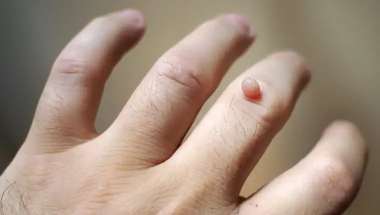Image of blemish that Cryotherapy Godalming can remove with Lipo 360.