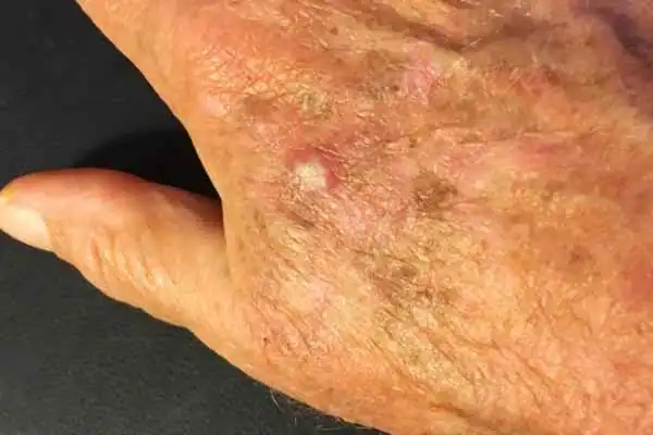 CryoPen for Actinic Keratoses 1 Image of Actinic keratoses Godalming on a person hand