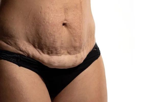 The science behind skin tightening Godalming picture of a woman's sagging skin on the stomach